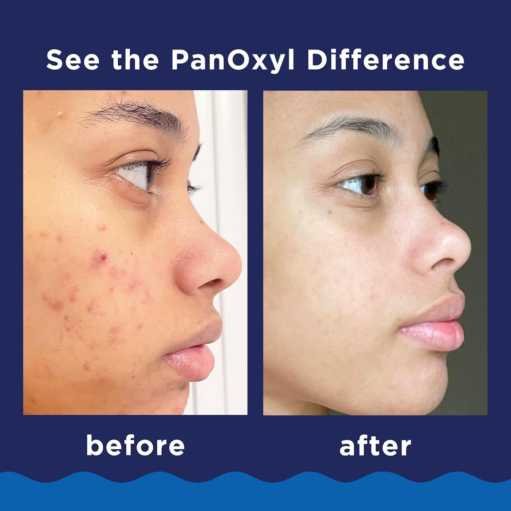 PanOxyl Acne Foaming Wash, 10% Benzoyl Peroxide, For Face & Body, 5.5 oz Jansha Store