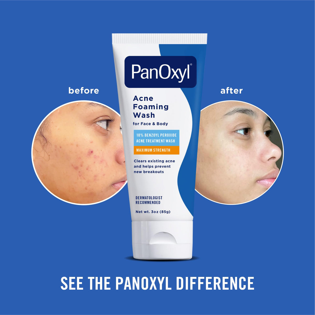 PanOxyl Acne Foaming Wash, 10% Benzoyl Peroxide, For Face & Body, 5.5 oz Jansha Store