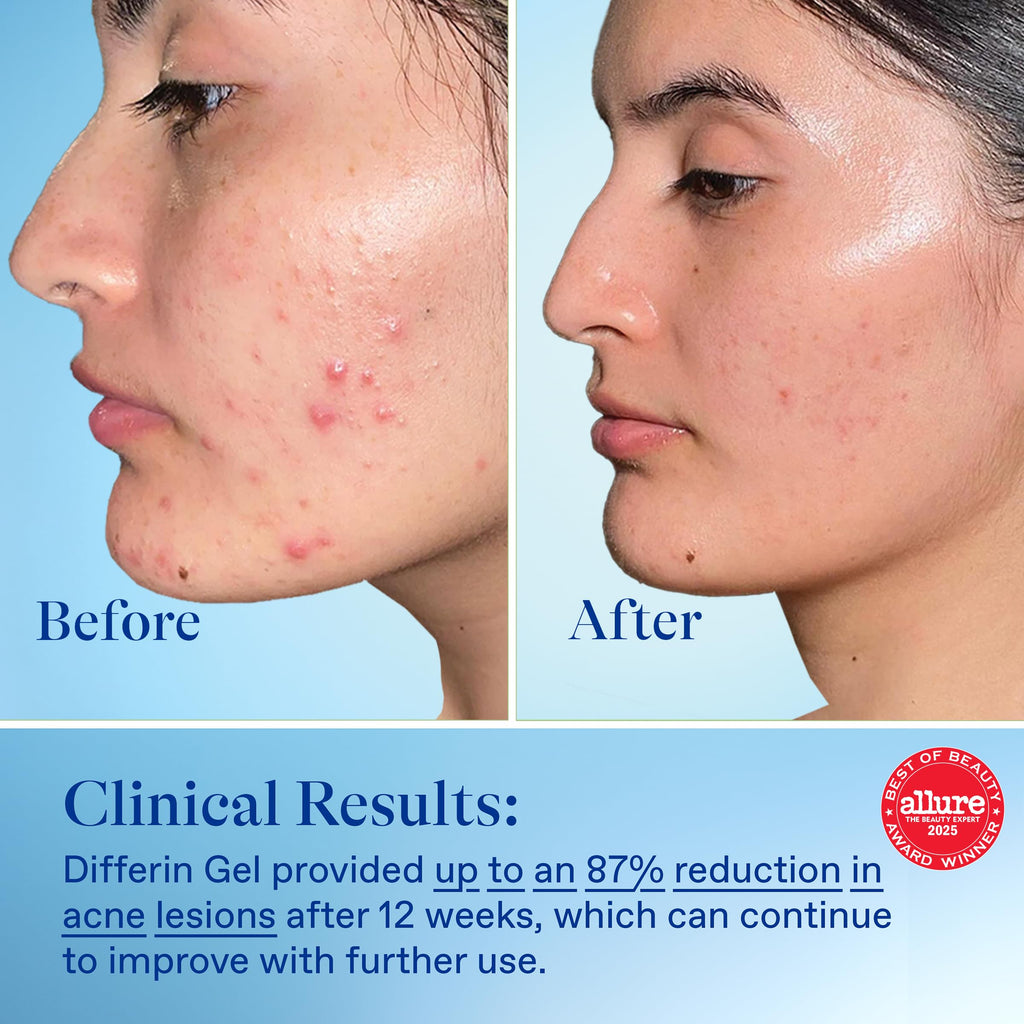 Differin Acne Retinoid Treatment Gel, 0.1% Adapalene, 15g Tube Jansha Store