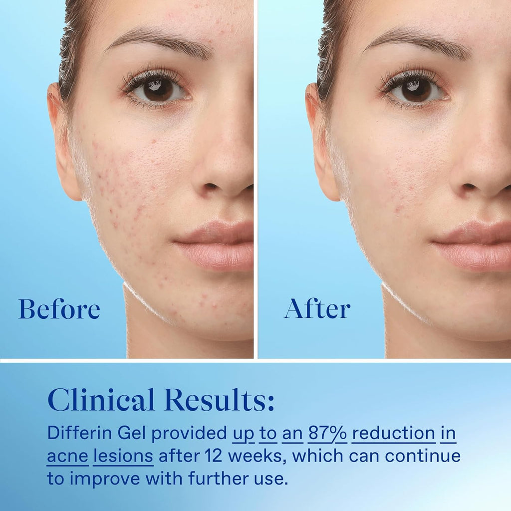 Differin Acne Retinoid Treatment Gel, 0.1% Adapalene, 15g Tube Jansha Store