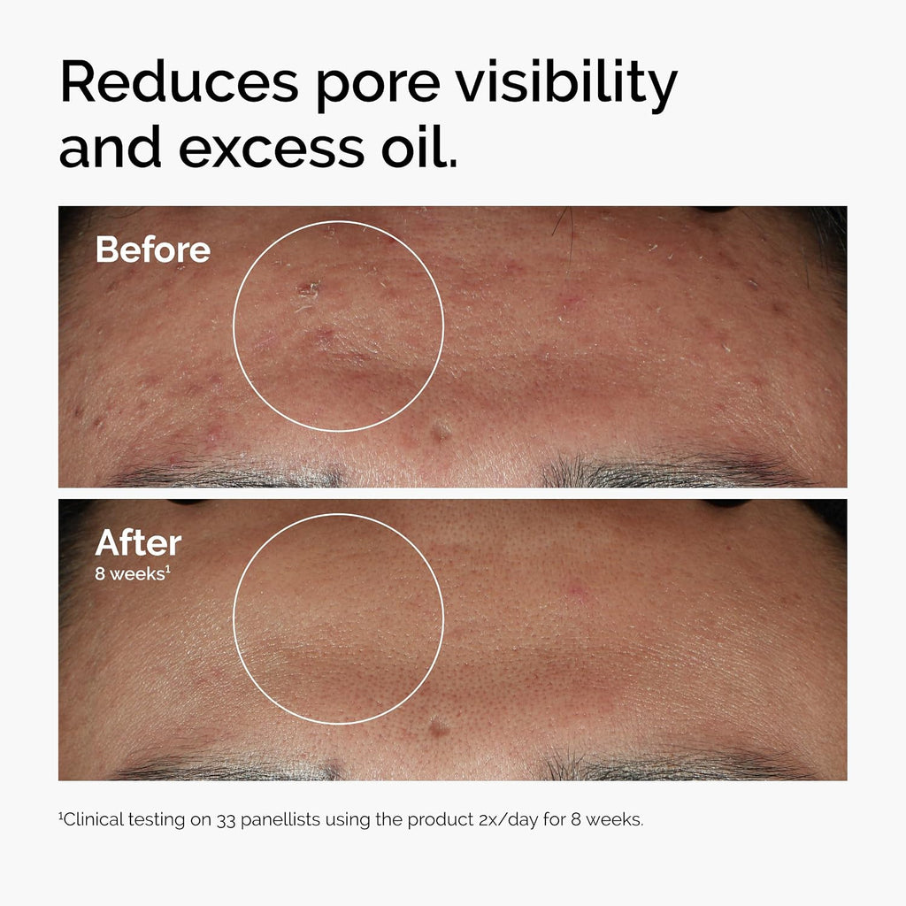 The Ordinary Niacinamide 10% + Zinc 1%, Smoothing Serum for Blemish-Prone Skin Jansha Store