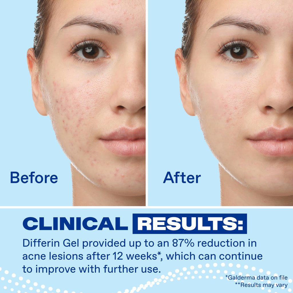 Differin Acne Retinoid Treatment Gel, 0.1% Adapalene, 15g Tube Jansha Store